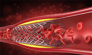 Se a estenose coronária for ≥ 50% e ≤ 70%, um stent deve ser colocado?