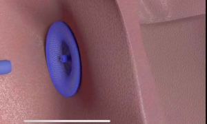 Lançado o primeiro oclusor totalmente absorvível do mundo