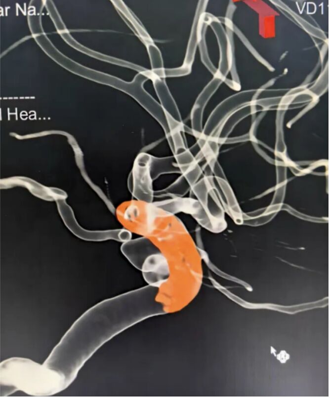 Clinical Spotlight | Simplificando o tratamento de aneurismas carotídeos em tandem com Nuva®Desversor fluxo