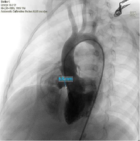 Reparo VSD Biodegradável MemoSorb: Protegendo o Crescimento na Complexidade Anatômica