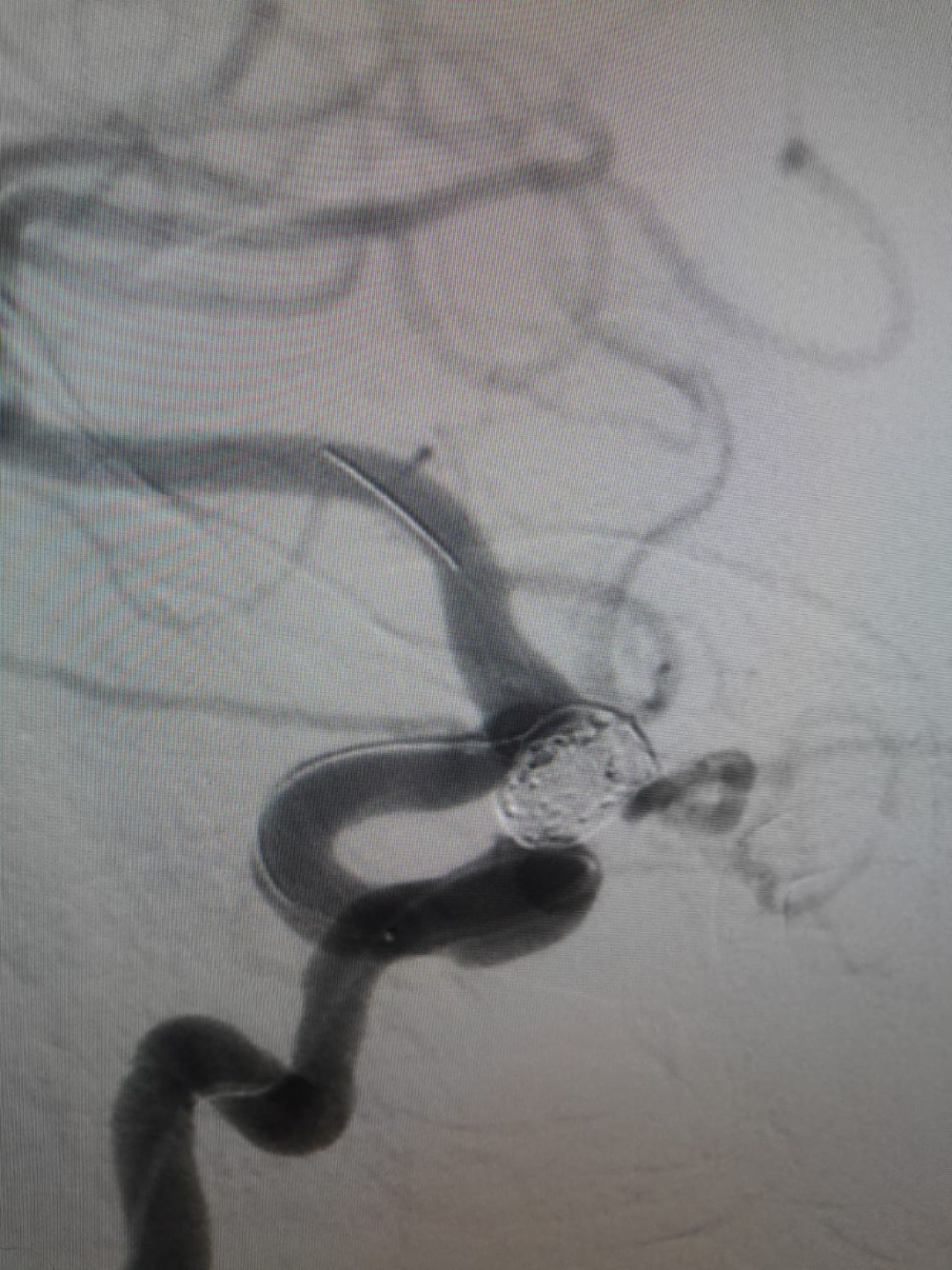 Spotlight Clínico | Nuva®Flow Diverter para Gestão Aneurisma Recorrente