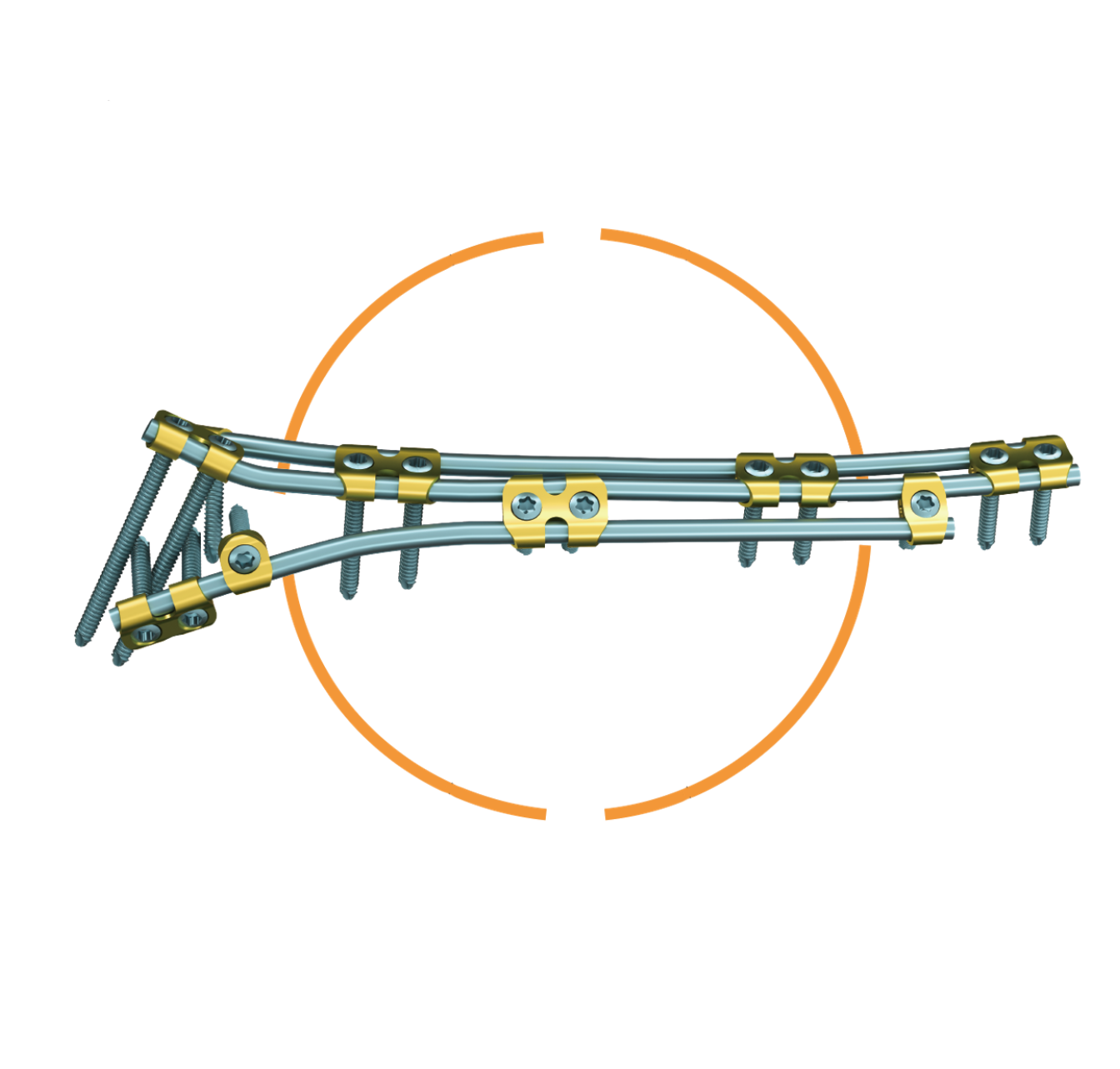 Sistema de Ponte Ortopédica (OBS)-Produto patenteado