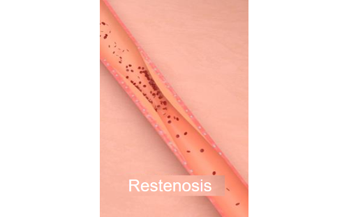 classswiperwrapper forview styletransform translate3d0px, 0px, 0px transitionduration 0ms Estenose d...