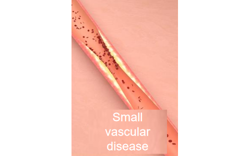 fanyiEstenose do stent Doena vascular pequena